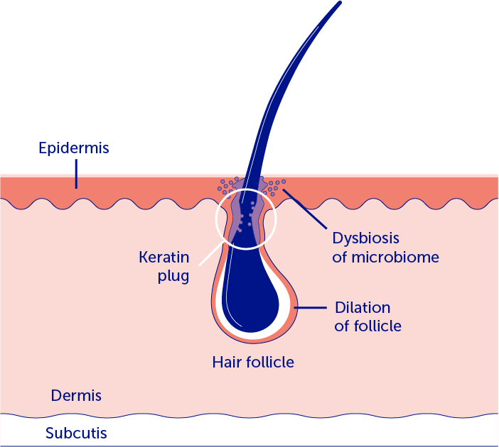 HS-pathogenesis_1.png